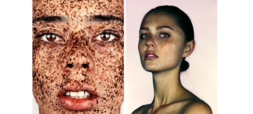 Project #Freckles belicht schoonheid van sproeten